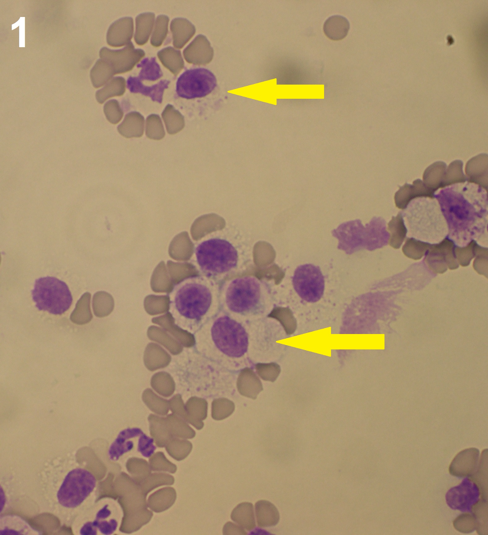  Figure 1: Mast cells (arrows) in the feathered edge of a canine blood smear.  The cells have small numbers of small faint pink intracytoplasmic granules. The smear was stained with Diff Quik.